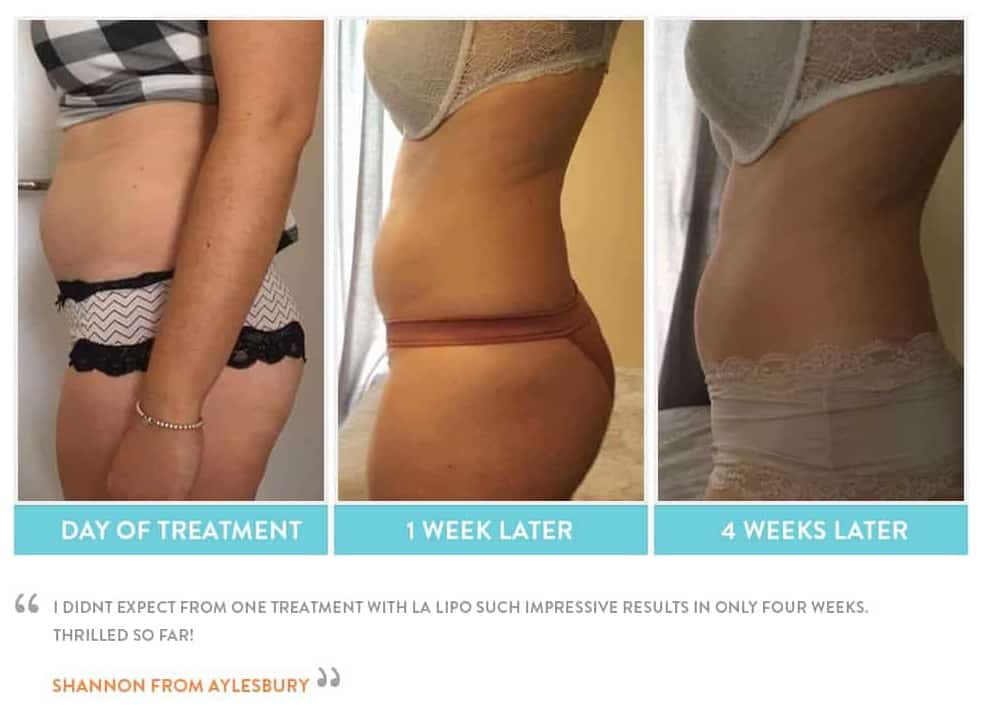 before, Cryolipolysis Crawley