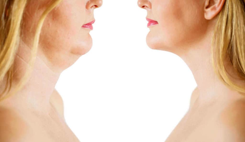 Double Chin treatment Crawley before and after results