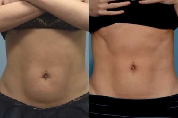 body sculpting FAQs Crawley
