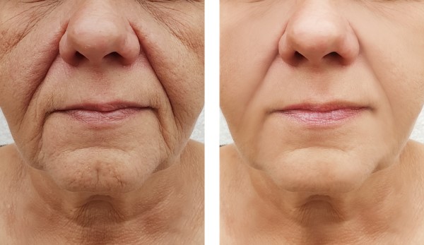 Learn more about Morpheus8 Treatment Crawley today!