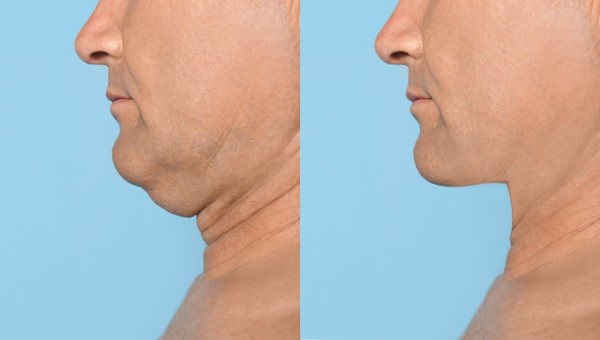 Which Non-Surgical Treatments Work Best for Jowls and Loose Skin Crawley?