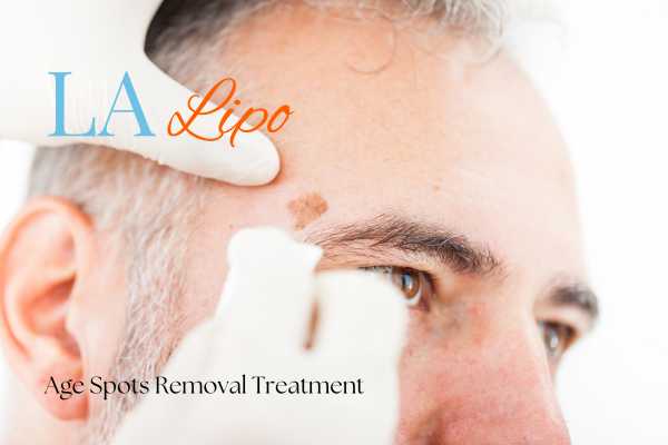What Are the Most Effective Treatments for Age Spots Crawley?