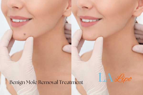 benign moles