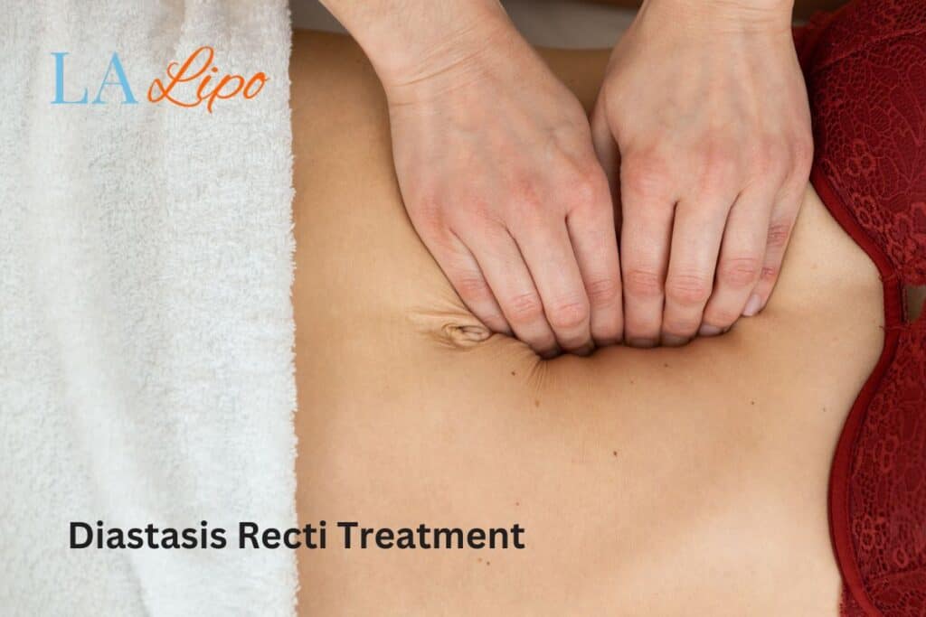 diastasis recti treatment