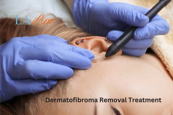 Dermatofibroma Removal Treatment Crawley
