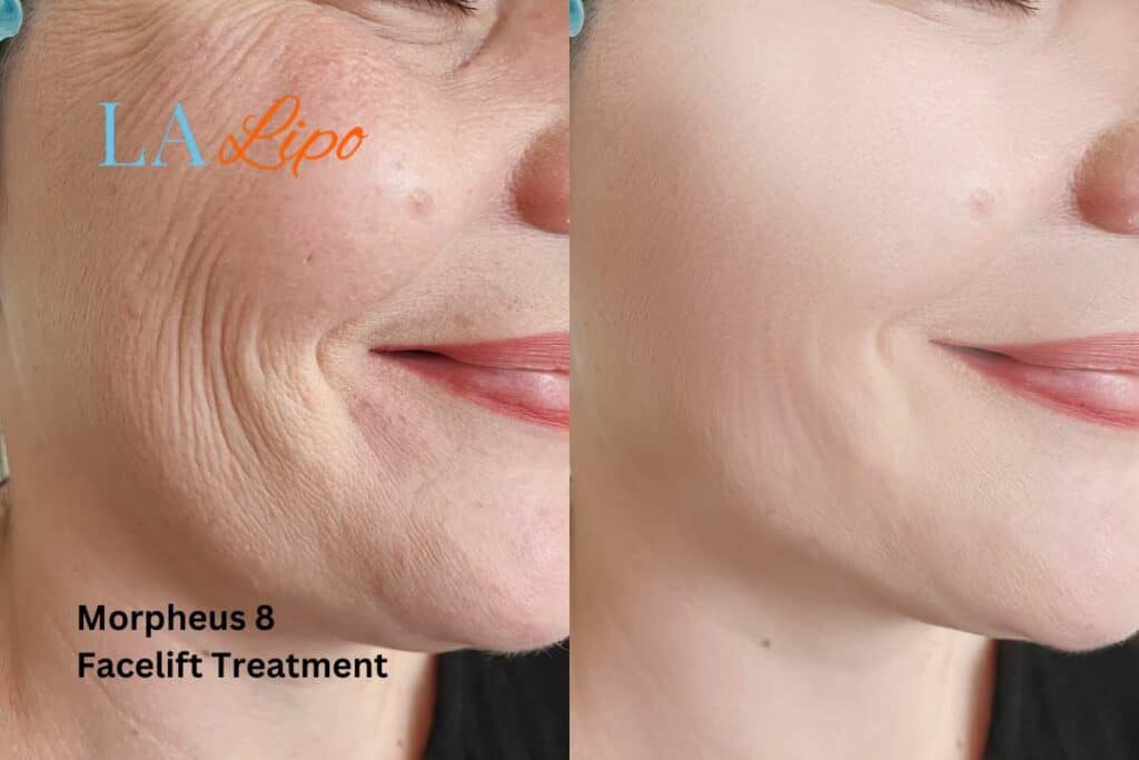 Morpheus8 Treatment Crawley for flawless skin! Call us today!