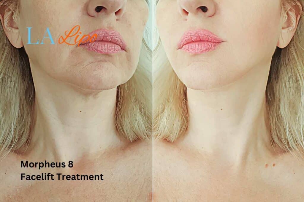 Turn back time with Morpheus8 Treatment Crawley
