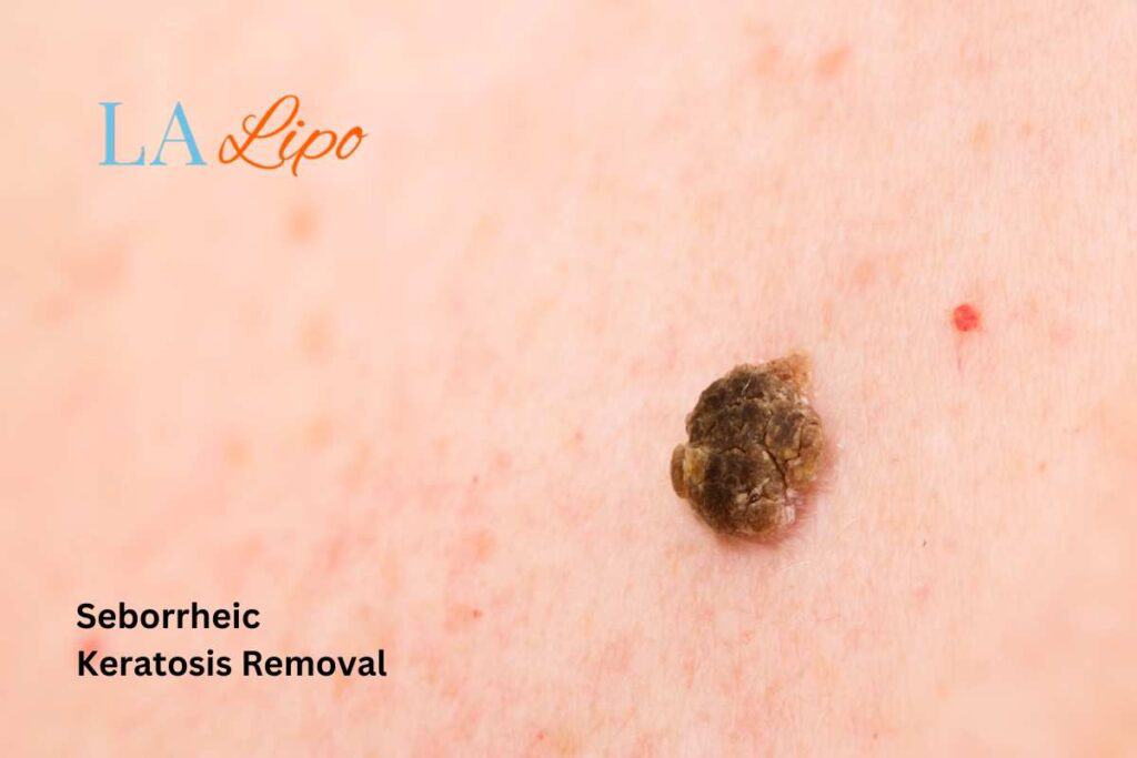 Seborrheic Keratosis