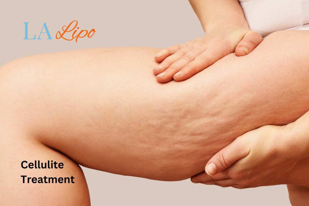 cellulite