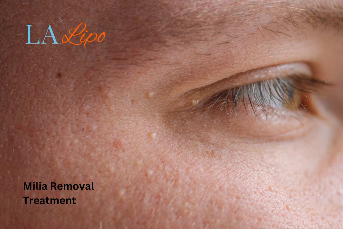 Cryopen Milia Removal: Is It the Easiest and Safest Option Crawley?