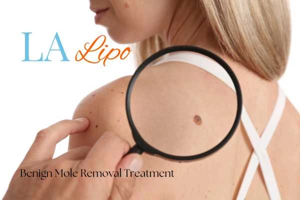 Woman having her inspection of blemish before mole removal Crawley
