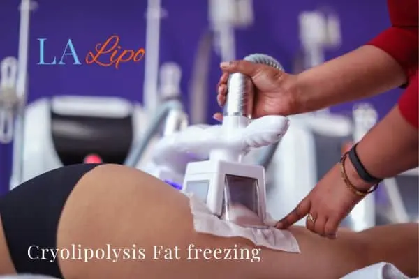 women getting fat freezing Crawley