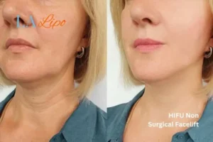 hi-fu for wrinkles Crawley before and after results