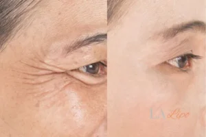 Before and after results of woman - HI-fu wrinkles reduction treatment Crawley