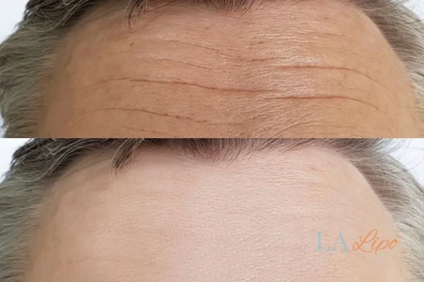 results of HIFU Crawley on mans forehead to help reduce lines and wrinkles