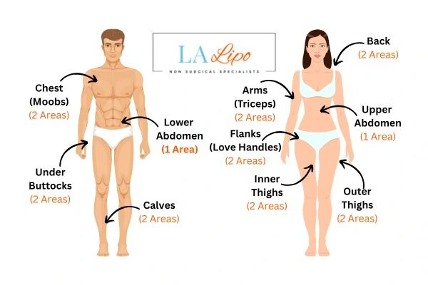 LA LIPO Cryolipolysis Areas Crawley