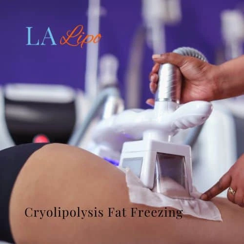 fat freezing - Cryolipolysis Crawley