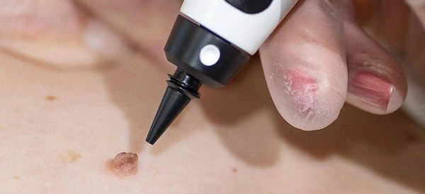skin tag removal using cryopen Crawley