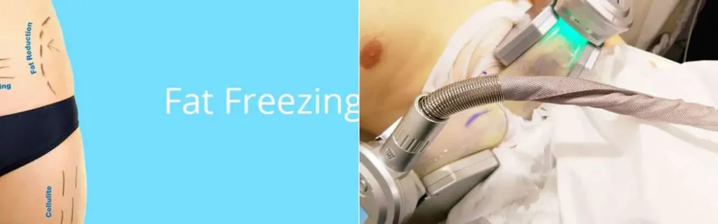 Fat freezing Crawley on multiple areas of the body