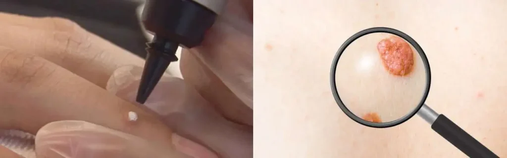 Cryopen for mole removal Crawley - speak to our team today!