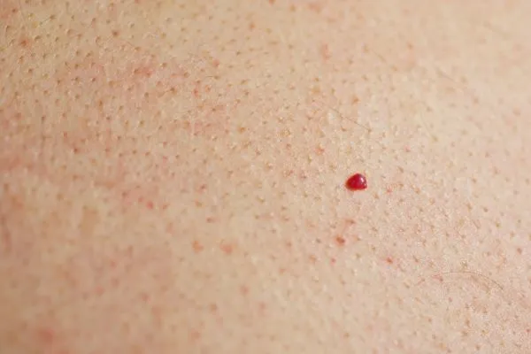 close up of a cherry angioma Crawley