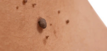 image of a skin tag Crawley