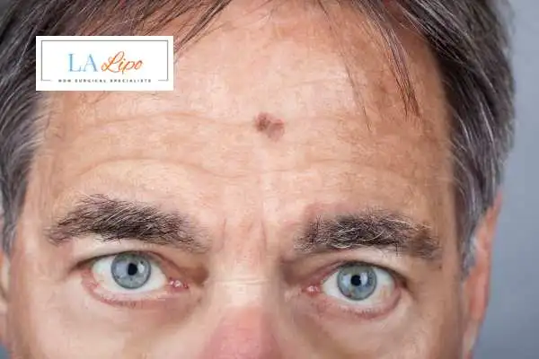 Solar Lentigo Removal Crawley image of man with mark on his forehead