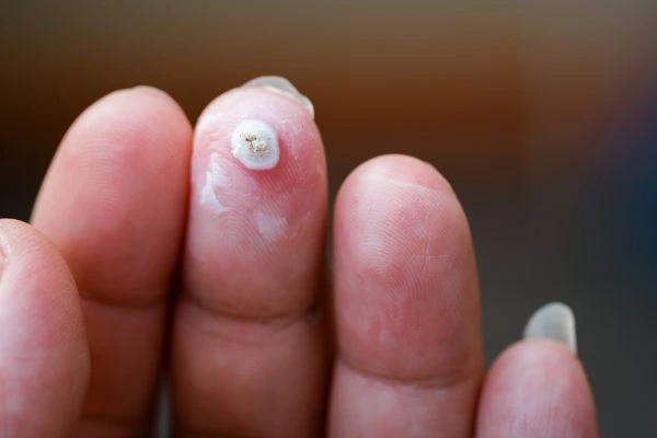 wart on person finger - cryotherapy to treat from LA LIPO Crawley