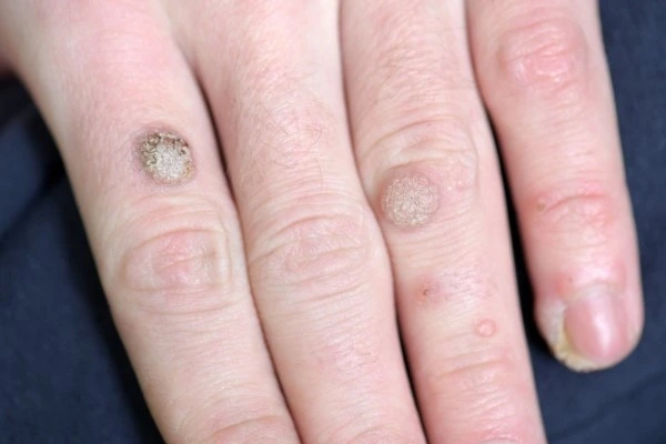 photo of warts on person hand - see wart removal Crawley from LA LIPO