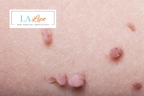 Does cryopen skin tag removal Crawley hurt? Find out now call our team today!