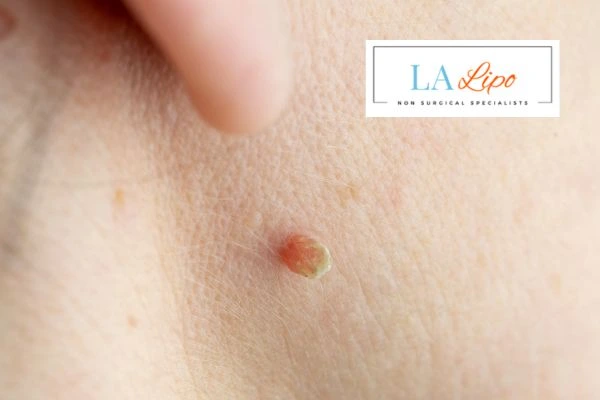 Book skin tag removal Crawley today speak to our team now!