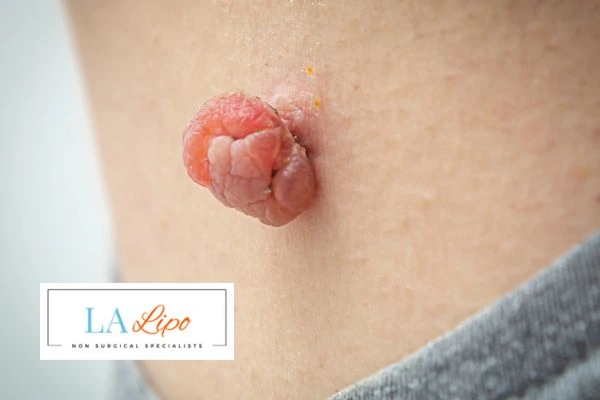 Interested in skin tag removal Crawley? Concerned about the pain? Find out more today!