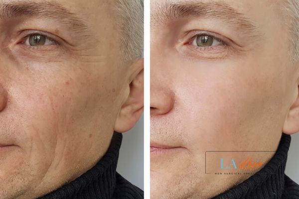 See the amazing results of Morpheus8 Treatment Crawley!