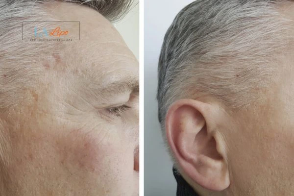Mens Before & After Morpheus 8 Results Crawley
