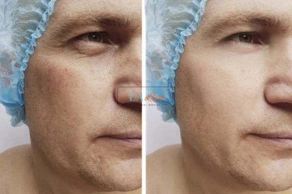 Before and after Morpheus 8 Results Crawley