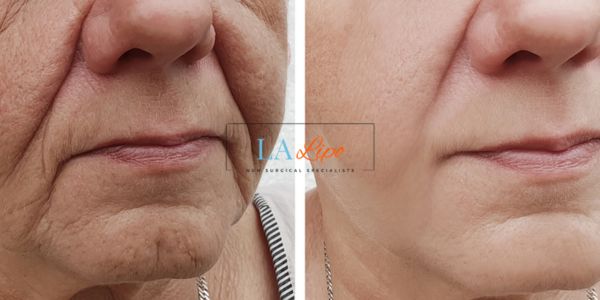 Older lady deeper wrinkle reduction - LA LIPO Morpheus 8 Results Crawley
