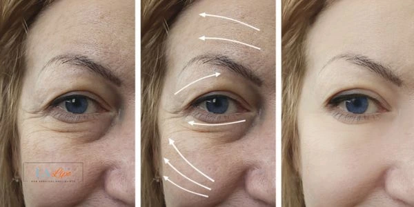 Amazing eye lift Morpheus 8 results Crawley