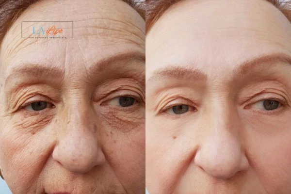 The powerful benefits of Morpheus8 Treatment Crawley - Call Our team today!