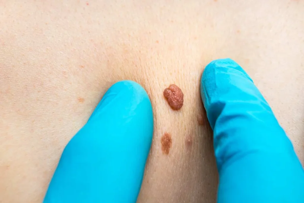 LA LIPO Cryopen Lesion Removal Prices Crawley