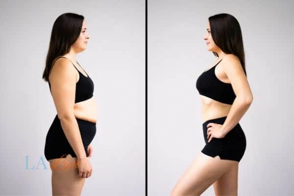 Picture of womans before and after using LA-EMS body sculpting to improve her core strength Crawley