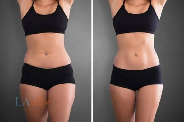 before and after results of non-surgical treatment to help a woman's body image and mental health Crawley
