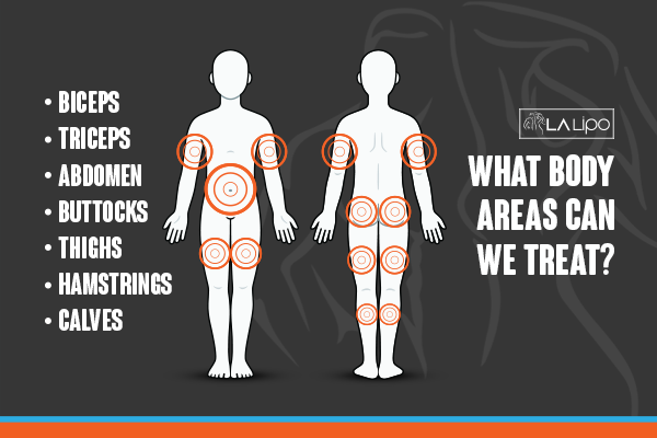 Diagram to show areas you can have LA-EMS Body Sculpting Treatment Crawley