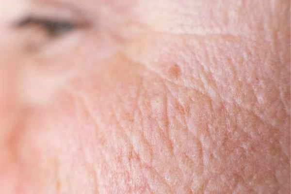 close up picture of a woman's face showing an age spot Crawley