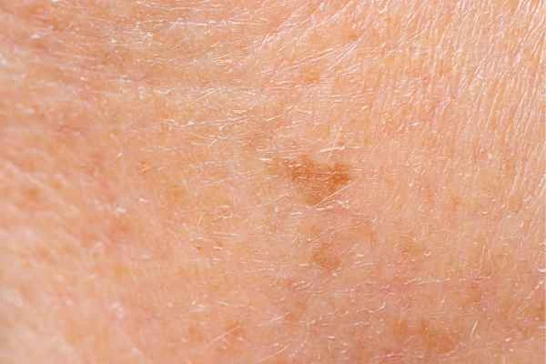 close up picture of age spots Crawley