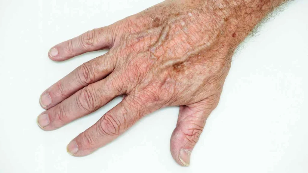 Male hand showing age spot Crawley