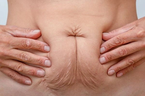 Image of a woman's stomach with loose skin - example of skin tightening Crawley options