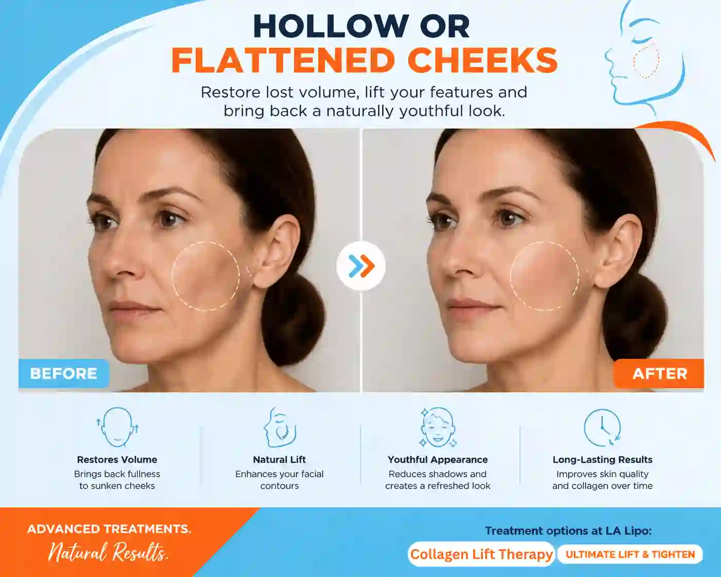Sign #4: Hollow or Flattened Cheeks Crawley
