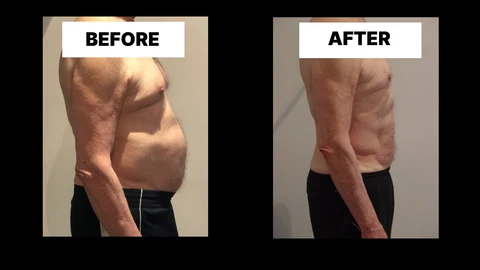 What Symptoms Can Diastasis Recti Cause in Men? Weak Core, Back Pain and Poor Posture Crawley